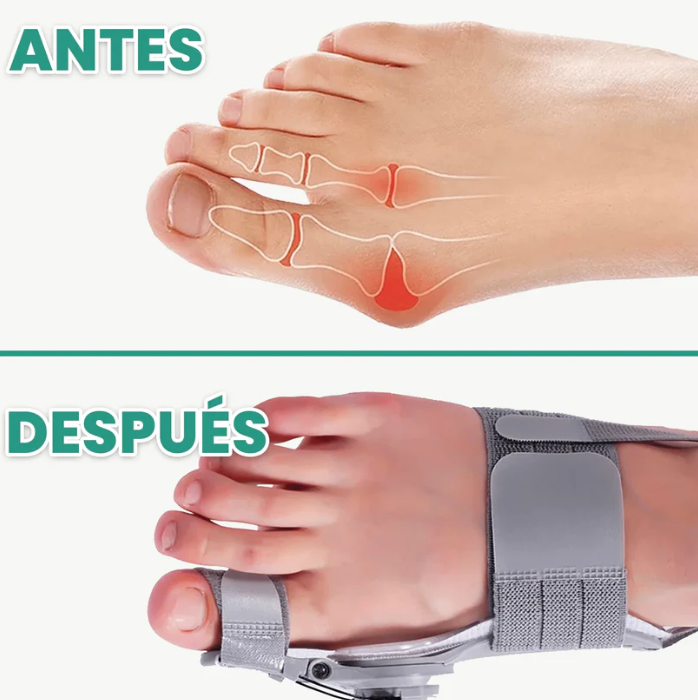 Corrector de Juanetes con Alivio del Dolor - Cómodo y Ajustable ✨