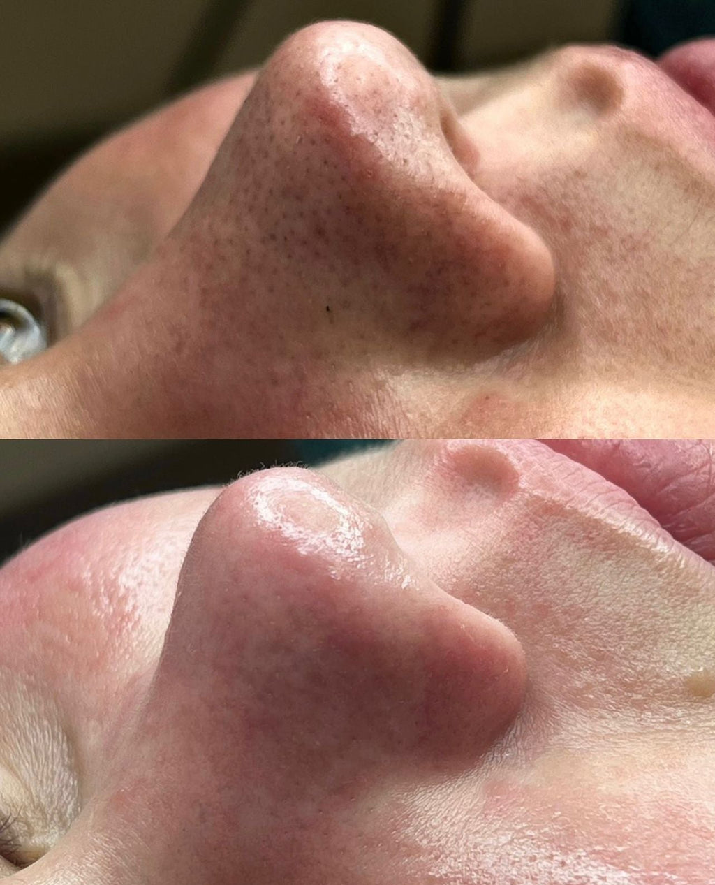 UltraScrub - Espátula Ultrasónica Facial